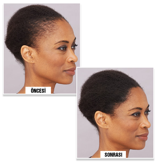 Bella A. before and after using Bunee