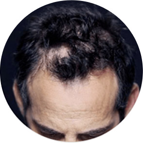 Hair with balding patch