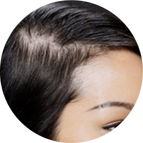 Hair with balding patch